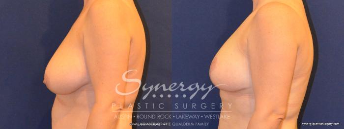 Before & After  Case 332 View #4 View in Austin, TX