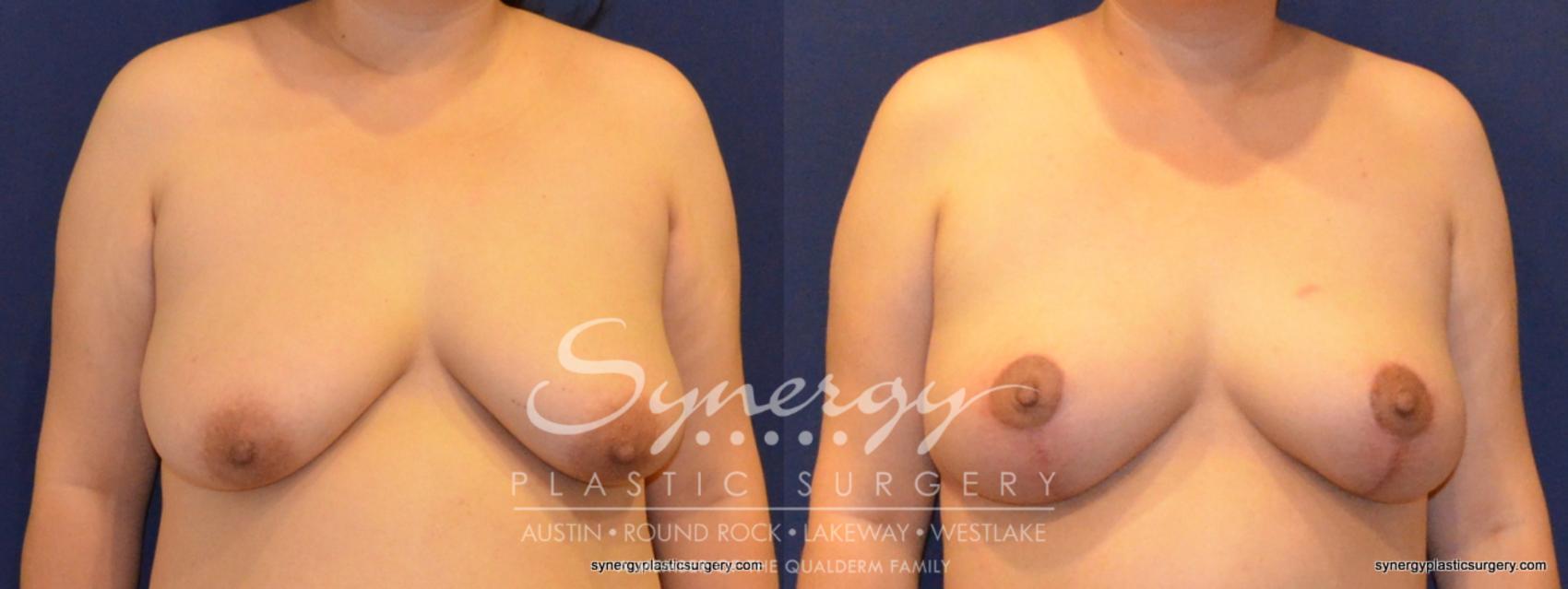 Before & After Breast Lift (Mastopexy) Case 396 View #1 View in Austin, TX