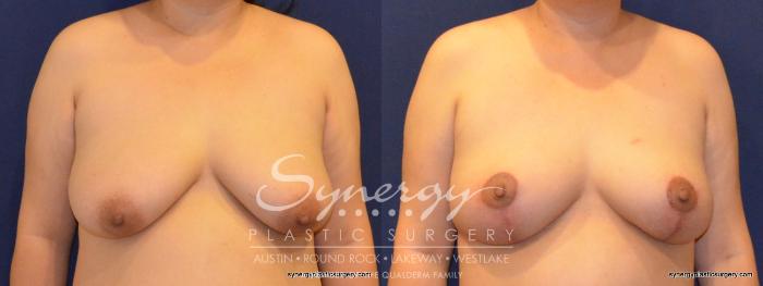 Before & After Breast Lift (Mastopexy) Case 396 View #1 View in Austin, TX