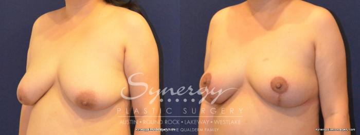 Before & After Breast Lift (Mastopexy) Case 396 View #5 View in Austin, TX