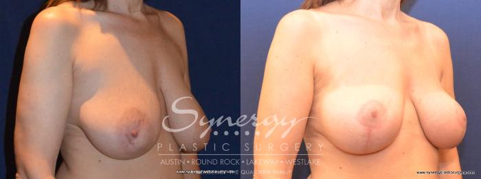 Before & After  Case 407 View #2 View in Austin, TX