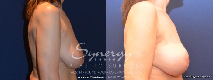 Before & After  Case 407 View #3 View in Austin, TX