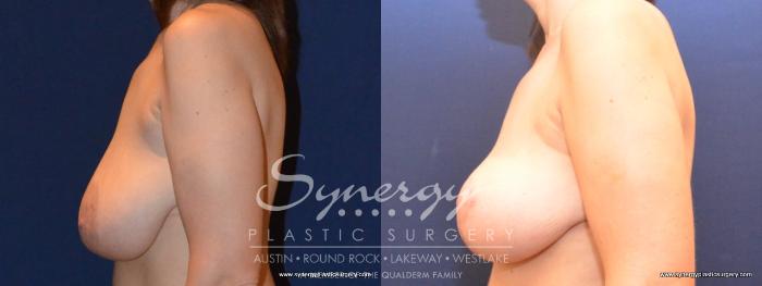 Before & After  Case 407 View #4 View in Austin, TX