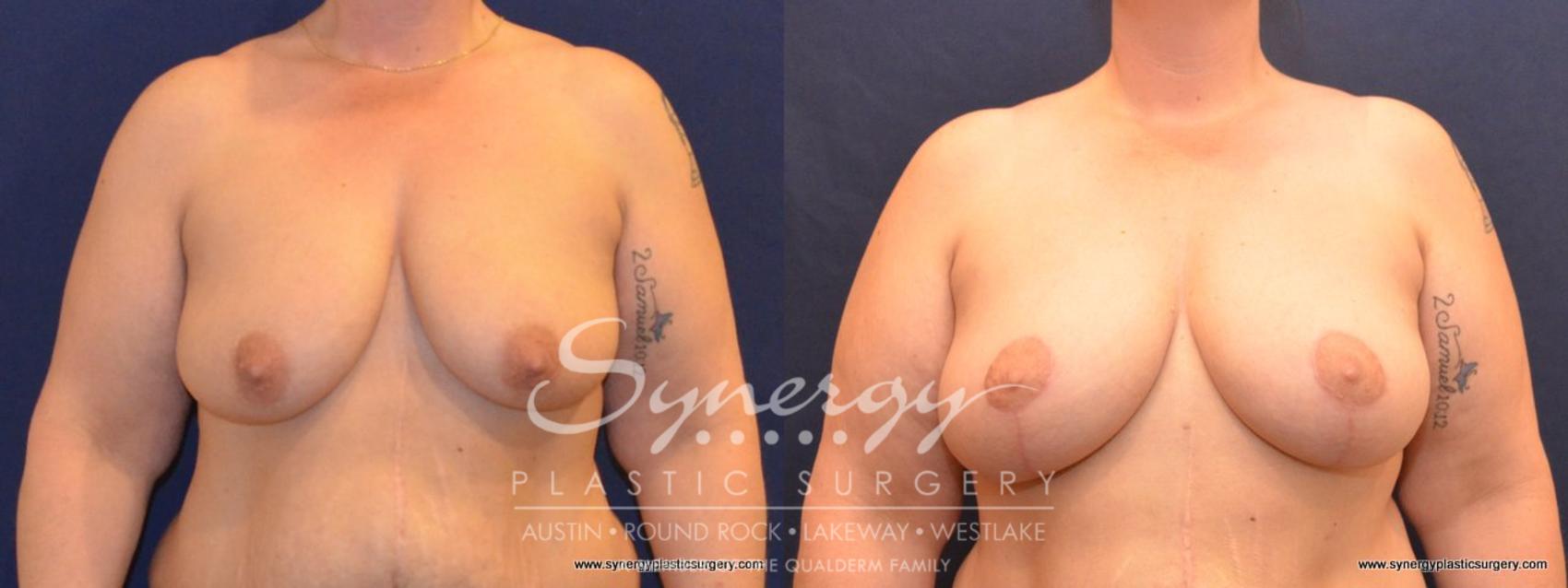 Before & After  Case 412 View #1 View in Austin, TX