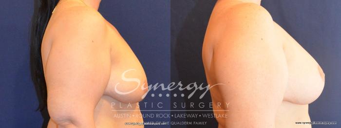 Before & After  Case 412 View #2 View in Austin, TX