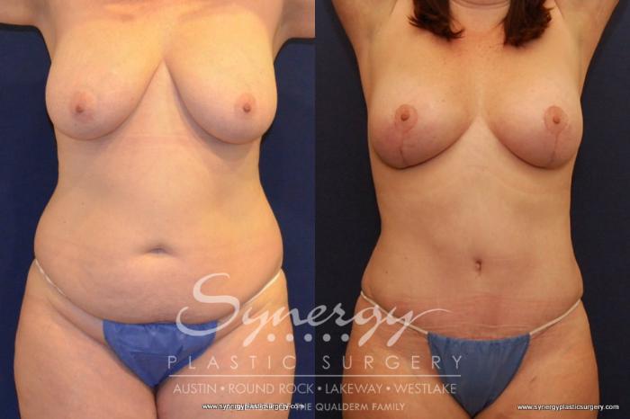 Before & After Breast Lift (Mastopexy) Case 434 View #2 View in Austin, TX