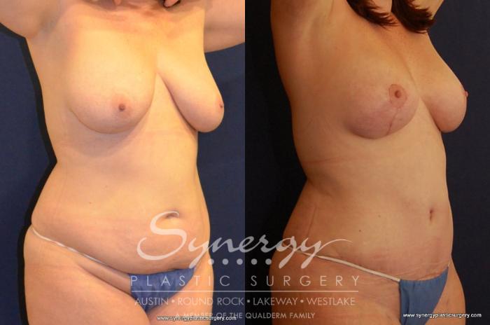 Before & After Breast Lift (Mastopexy) Case 434 View #4 View in Austin, TX