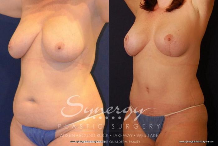 Before & After Breast Lift (Mastopexy) Case 434 View #6 View in Austin, TX
