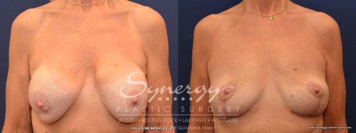 Before & After Breast Lift (Mastopexy) Case 438 View #1 View in Austin, TX