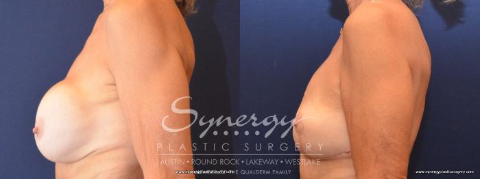 Before & After  Case 438 View #2 View in Austin, TX