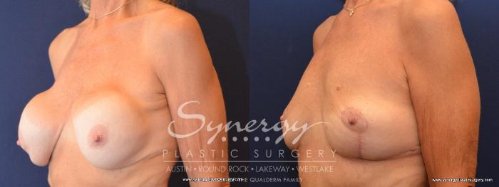 Before & After  Case 438 View #3 View in Austin, TX