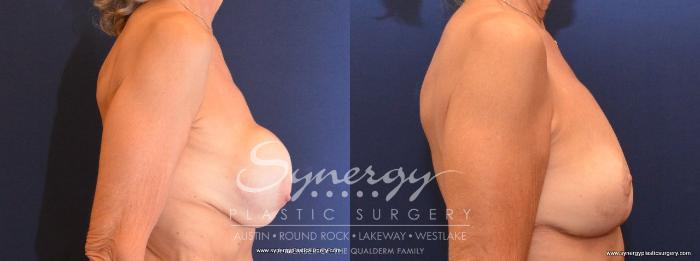 Before & After  Case 438 View #4 View in Austin, TX