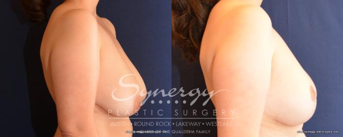 Before & After Breast Lift (Mastopexy) Case 489 View #3 View in Austin, TX