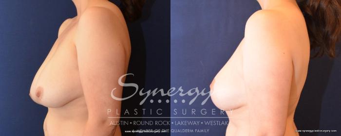 Before & After Breast Lift (Mastopexy) Case 489 View #5 View in Austin, TX