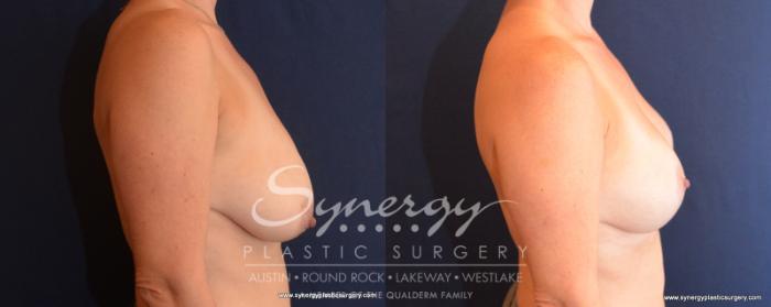 Before & After Breast Lift (Mastopexy) Case 507 View #2 View in Austin, TX