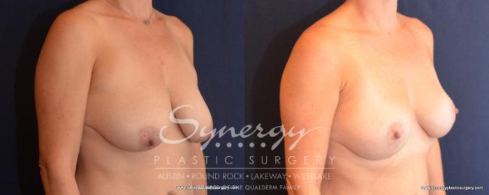 Before & After Breast Lift (Mastopexy) Case 507 View #3 View in Austin, TX