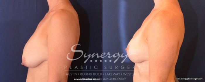 Before & After Breast Lift (Mastopexy) Case 507 View #4 View in Austin, TX