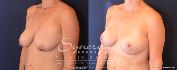 Before & After Breast Lift (Mastopexy) Case 507 View #5 View in Austin, TX