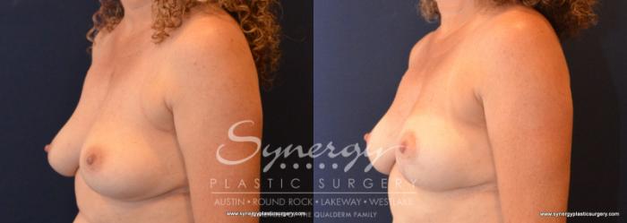 Before & After Breast Lift (Mastopexy) Case 596 View #2 View in Austin, TX