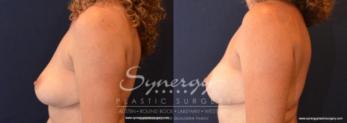 Before & After Breast Lift (Mastopexy) Case 596 View #3 View in Austin, TX