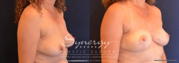 Before & After Breast Lift (Mastopexy) Case 596 View #4 View in Austin, TX