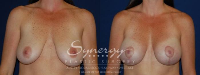 Before & After  Case 64 View #2 View in Austin, TX