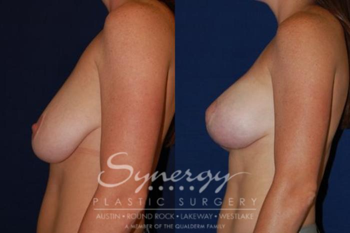 Before & After  Case 64 View #5 View in Austin, TX