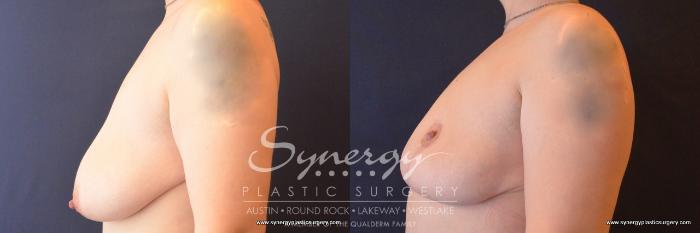 Before & After Breast Lift (Mastopexy) Case 787 View #3 View in Austin, TX