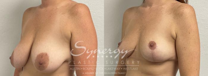 Before & After Breast Lift (Mastopexy) Case 899 Left Oblique View in Austin, TX