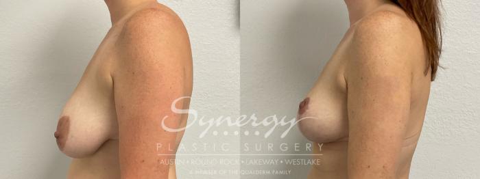 Before & After Breast Lift (Mastopexy) Case 899 Left Side View in Austin, TX