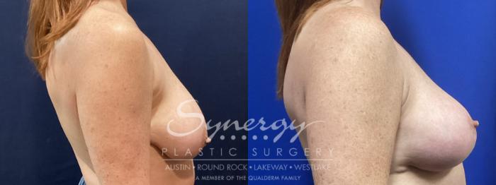 Before & After Breast Lift (Mastopexy) Case 903 Right Side View in Austin, TX
