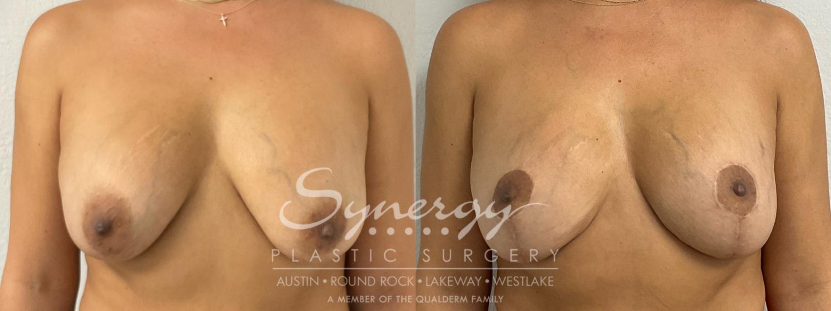 Breast Lift Before & After Photos | 42-Year-Old Patient | Synergy Plastic Surgery Austin