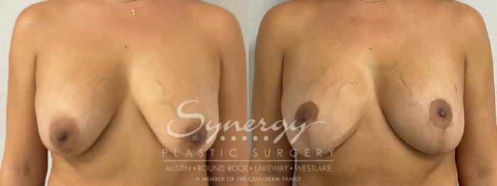 Breast Lift Before & After Photos | 42-Year-Old Patient | Synergy Plastic Surgery Austin