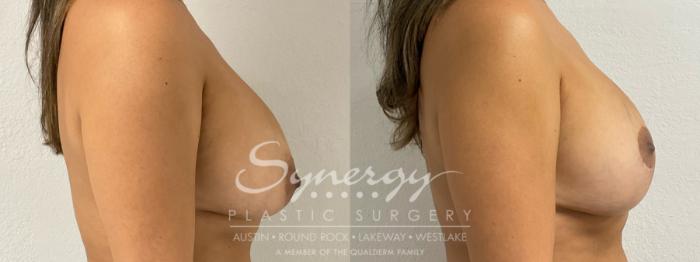 Before & After Breast Lift (Mastopexy) Case 956 Right Side View in Austin, TX