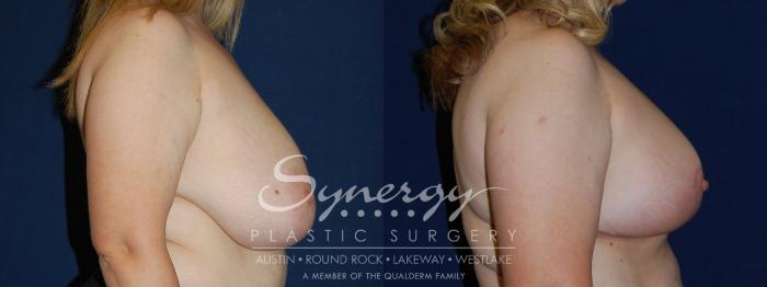 Before & After Breast Reduction Case 114 View #3 View in Austin, TX