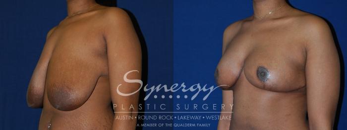Before & After Breast Reduction Case 131 View #3 View in Austin, TX