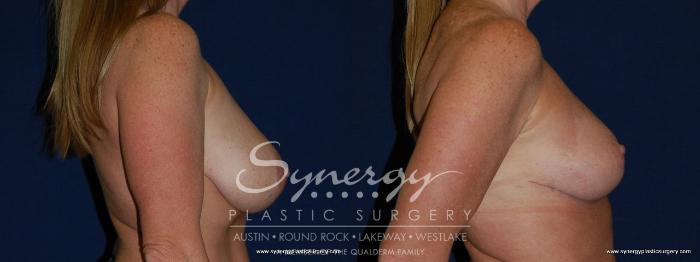 Before & After Breast Reduction Case 146 View #1 View in Austin, TX