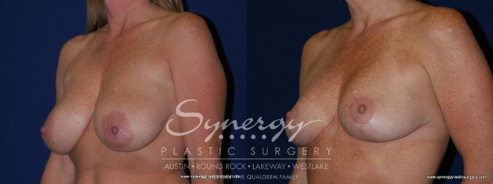 Before & After  Case 146 View #2 View in Austin, TX