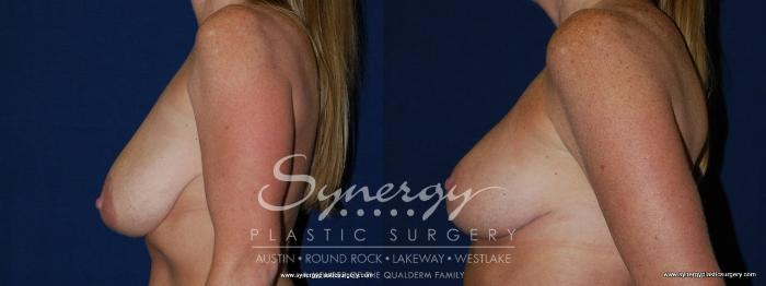 Before & After  Case 146 View #4 View in Austin, TX