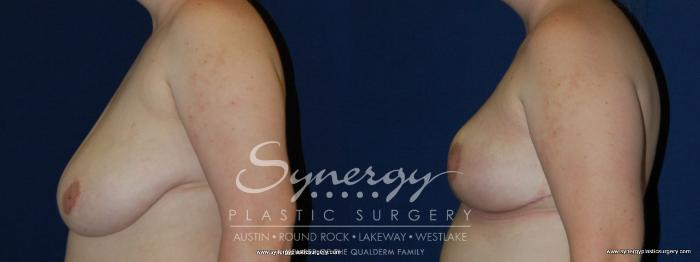 Before & After Breast Reduction Case 164 View #3 View in Austin, TX