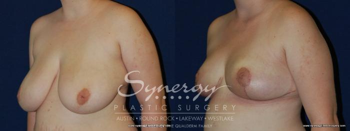 Before & After Breast Reduction Case 164 View #4 View in Austin, TX