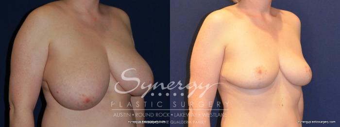 Before & After Breast Reduction Case 208 View #1 View in Austin, TX