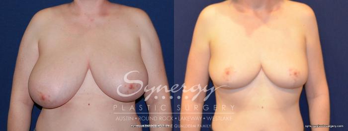 Before & After  Case 208 View #2 View in Austin, TX