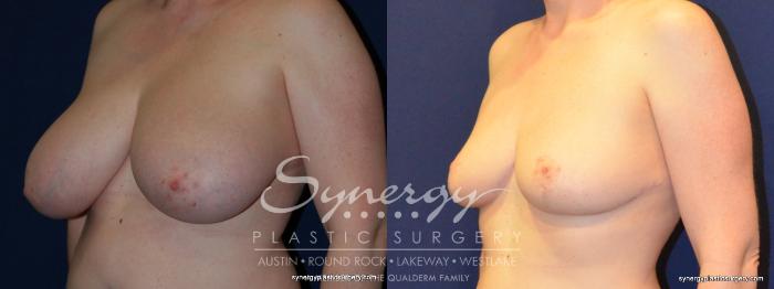 Before & After  Case 208 View #3 View in Austin, TX