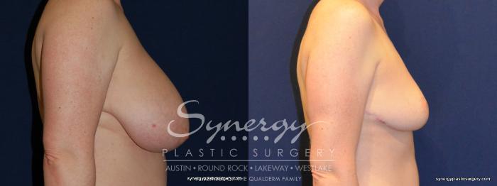 Before & After  Case 208 View #5 View in Austin, TX