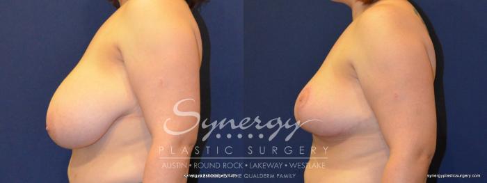 Before & After Breast Reduction Case 231 View #2 View in Austin, TX