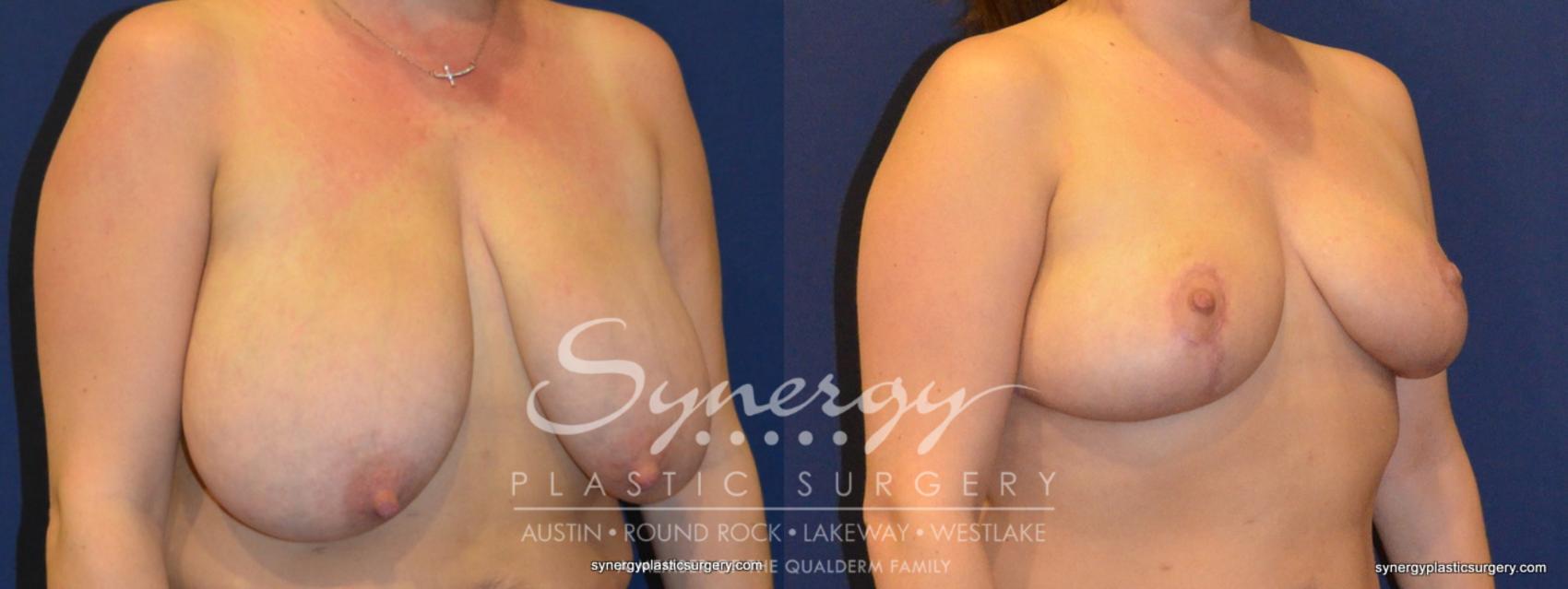 Before & After Breast Reduction Case 271 View #1 View in Austin, TX