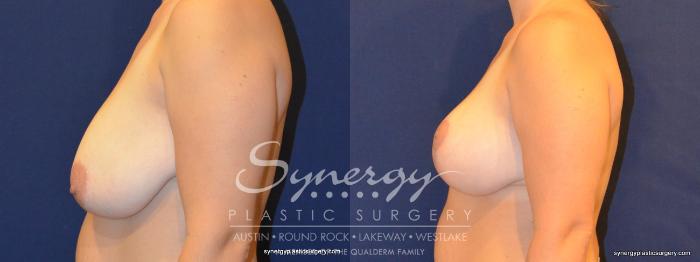 Before & After  Case 324 View #2 View in Austin, TX