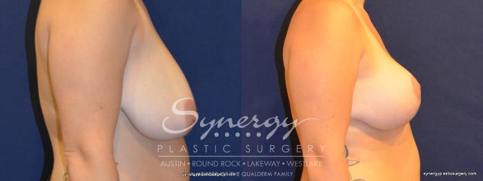 Before & After  Case 324 View #4 View in Austin, TX