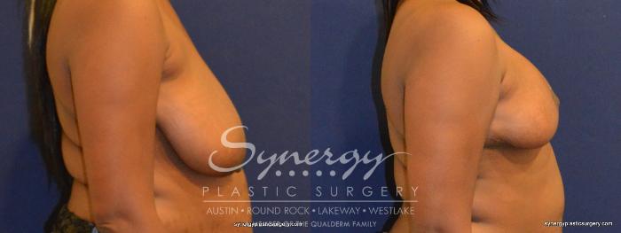 Before & After  Case 349 View #2 View in Austin, TX